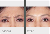 Botox Before and After Photos